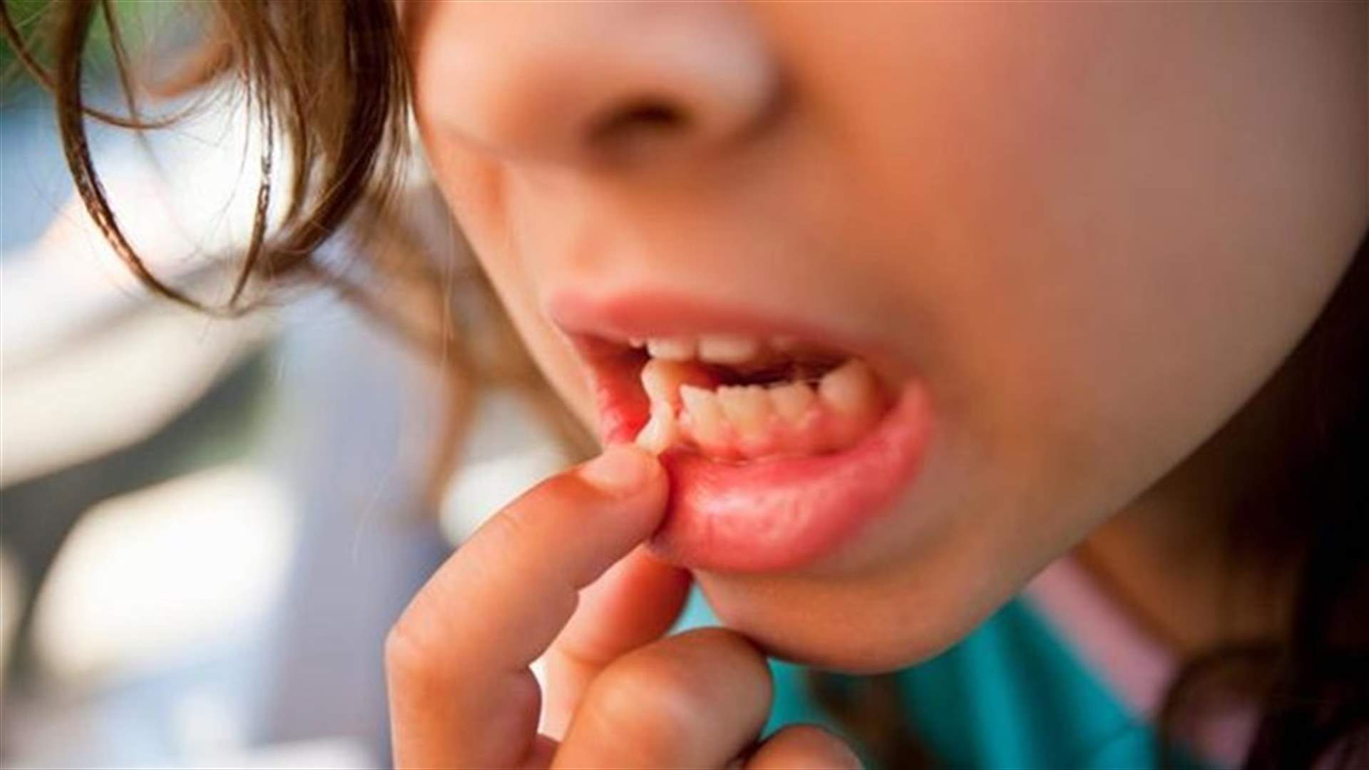 6. <br/>علاج الأسنان المتخلخلة: الممكنات والطرق الفعالة.