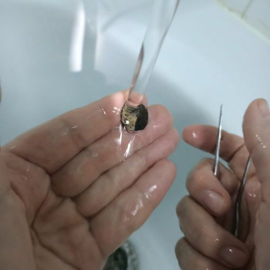 الأطباء يستخرجون عملة معدنية من أنف رجل