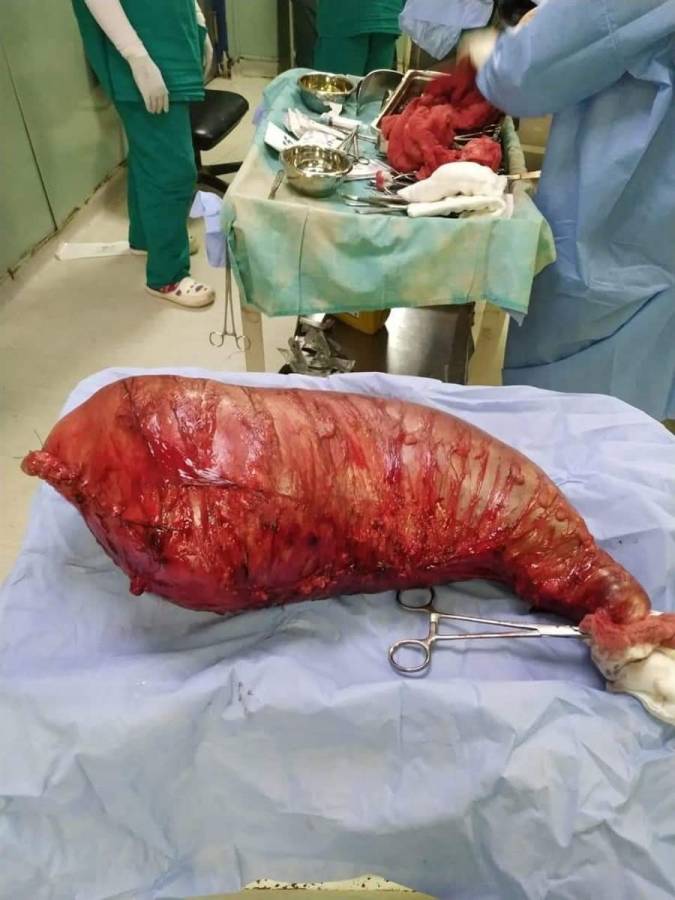 استئصال كتلة وزنها 15 كيلوغراماً من بطن مصري