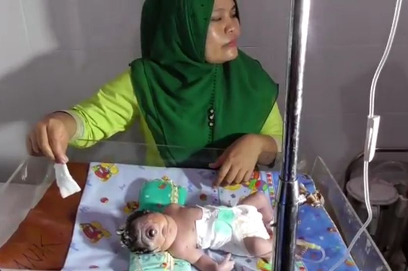 ولادة طفلة بعين واحدة ومن دون أنف