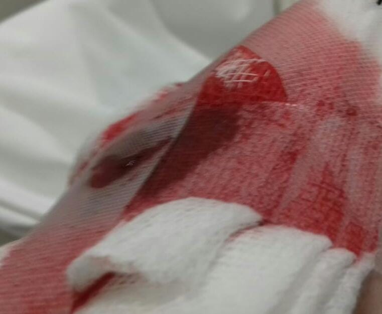 باتريك مبارك مضرّجاً بالدماء بسبب الرصاص المطاطي.. "3 ساعات وقطع شريان وعصب"