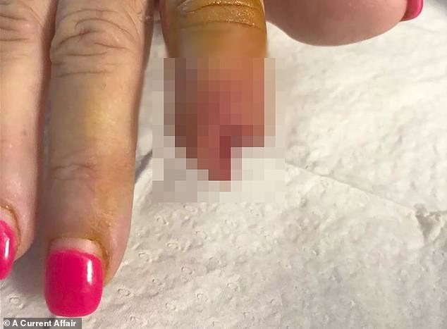 بُتر إصبعها بعد تقليم أظافرها في صالون! خضعت لعملية جراحية لبتر إصبعها
