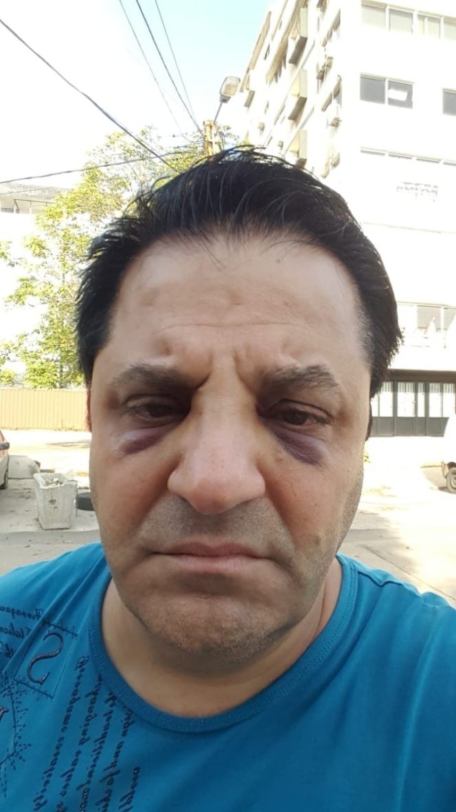 فنان لبناني يتعرّض للضرب المبرح على مدخل جامعة الكسليك.. الكدمات على وجهه بالصور