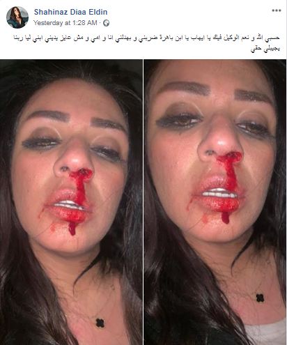 نجمة ستار أكاديمي تنشر صورها وهي تنزف: زوجي ضربني!
