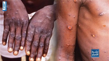 Monkeypox: What you need to know-[REPORT]