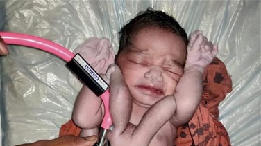 Lebanon News - معجزة الطبيعة... ولادة طفل بأربعة أذرع وأرجل في الهند (صور)
