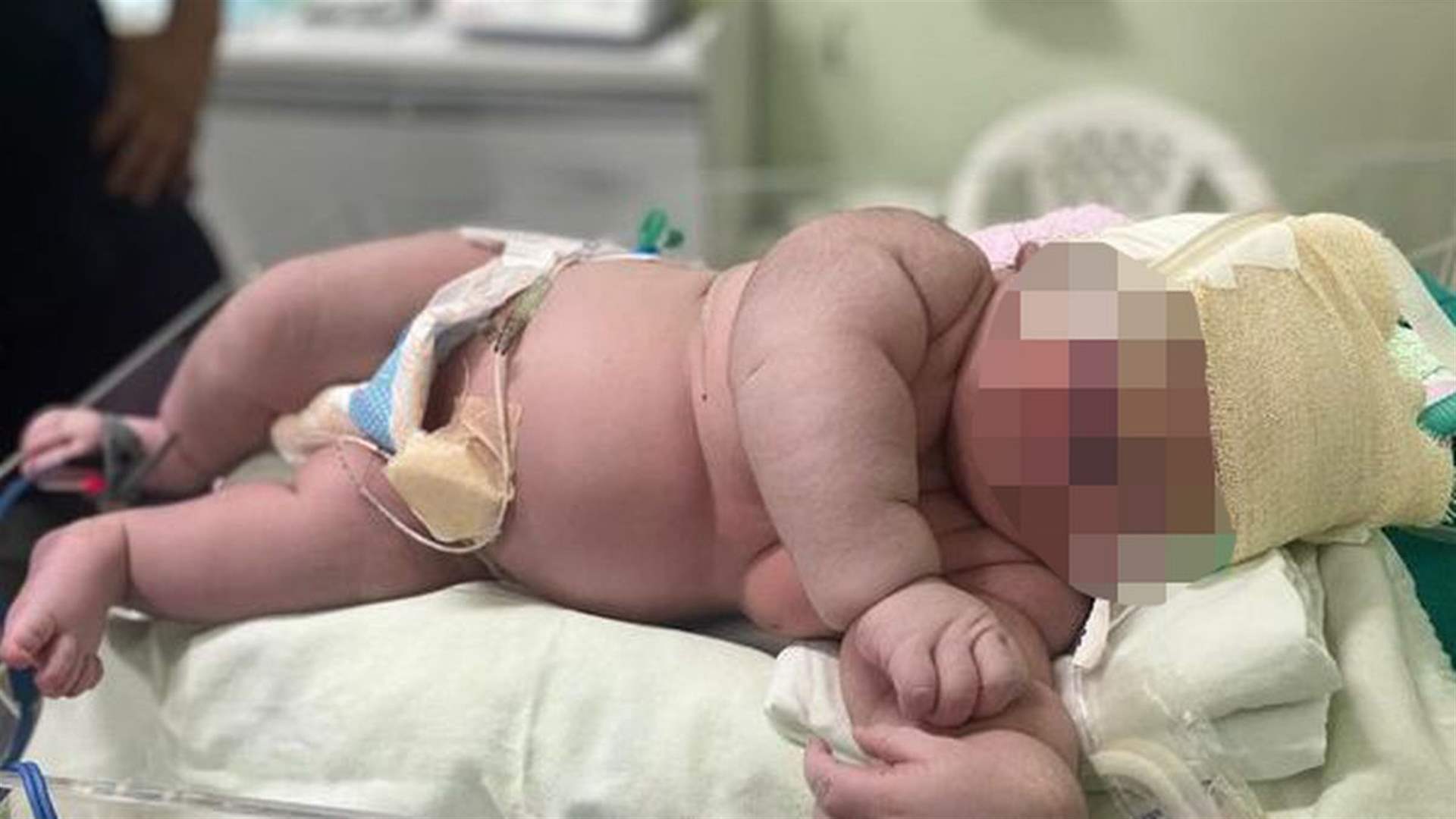 ولادة نادرة في البرازيل... وزن الرضيع تخطى الـ7 كيلوغرامات! (صور)