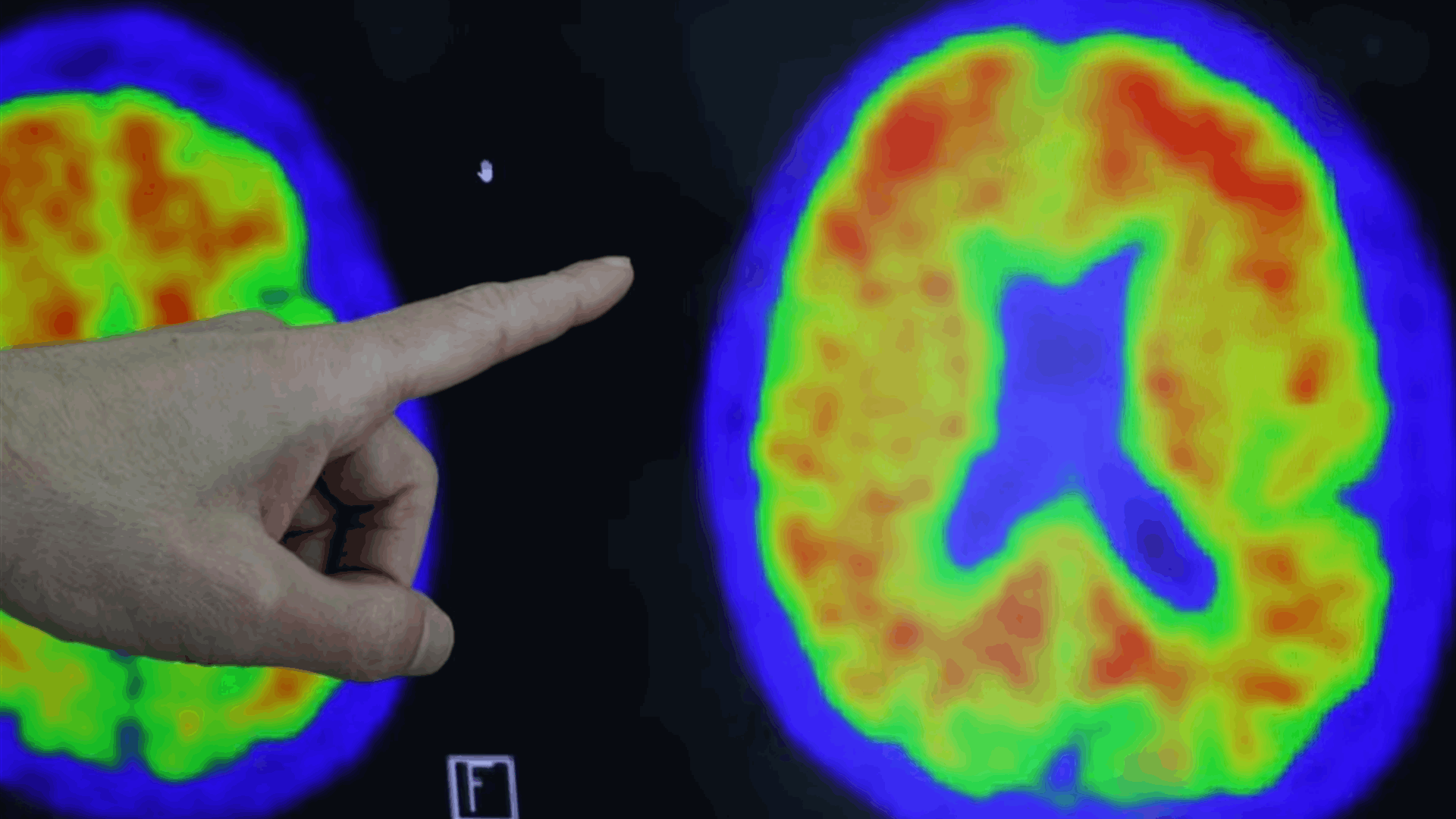 US to build $300 mln database to fuel Alzheimer's research