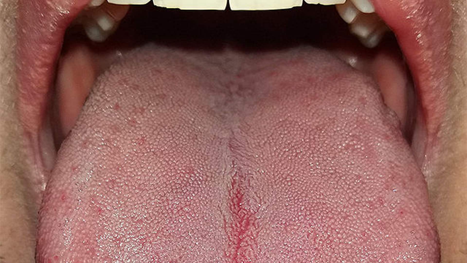 تحوّل لسناه إلى اللون الأخضر ونمت عليه شعيرات صغيرة... حالة غريبة وصادمة وهكذا فسّرها الأطباء! (صور)