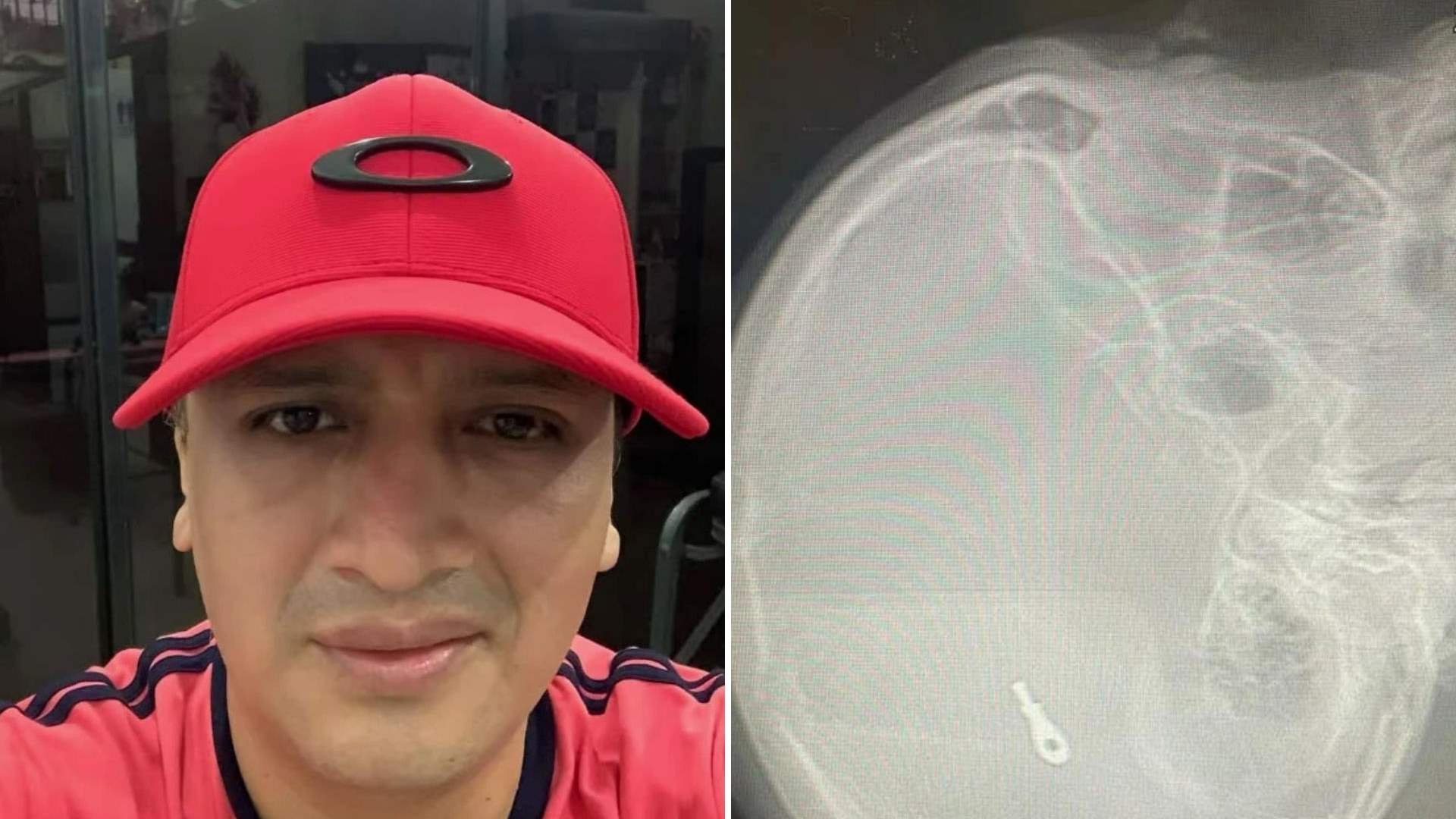 تلف جزء من دماغه أثناء عملية تجميل لأنفه... توفي بطريقة مأساوية بسبب مشبك معدني؟! 