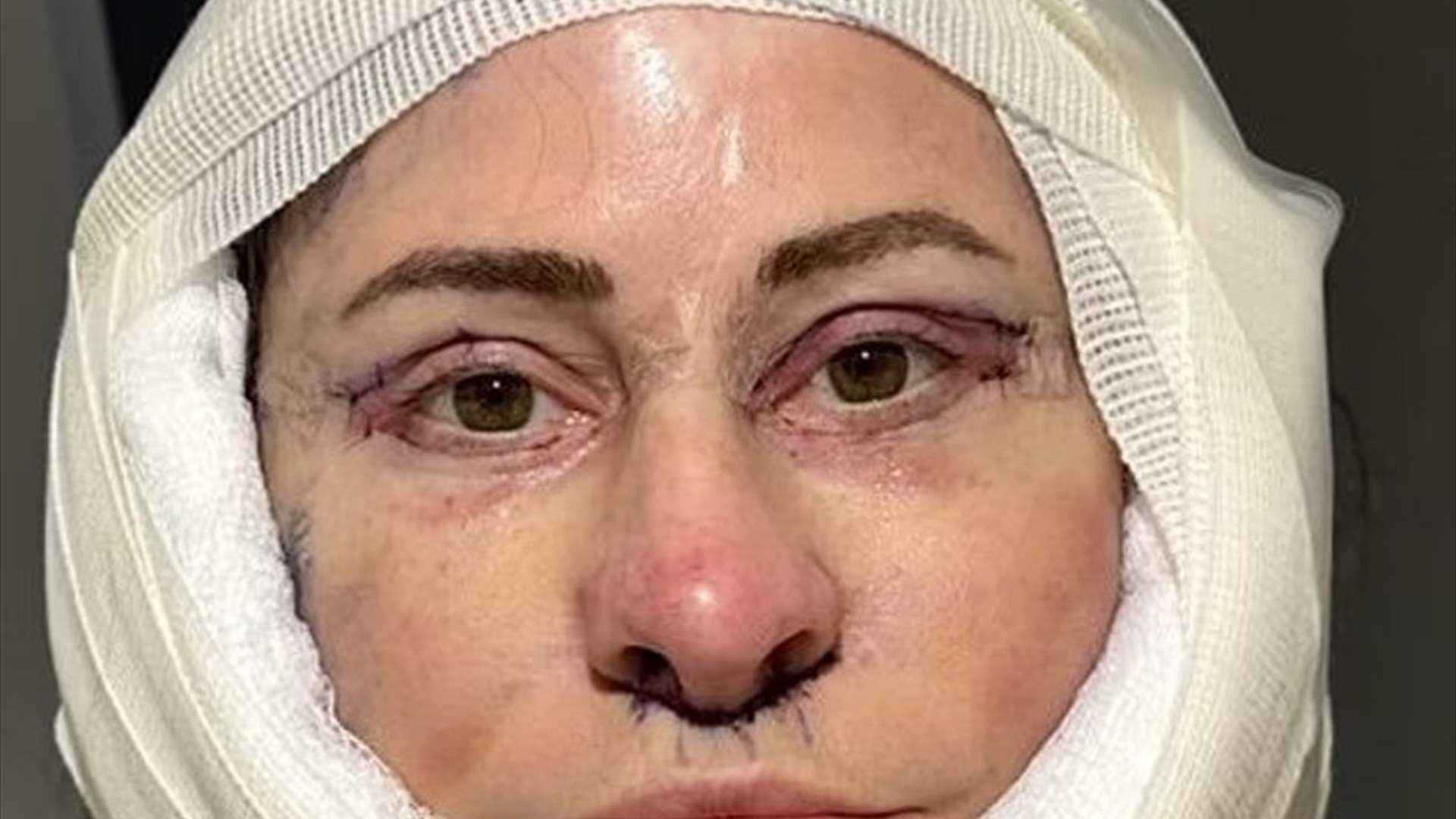 امراة تبيع منزلها لاجراء سلسلة عمليات تجميل... وهكذا أصبحت ملامحها! (صور)