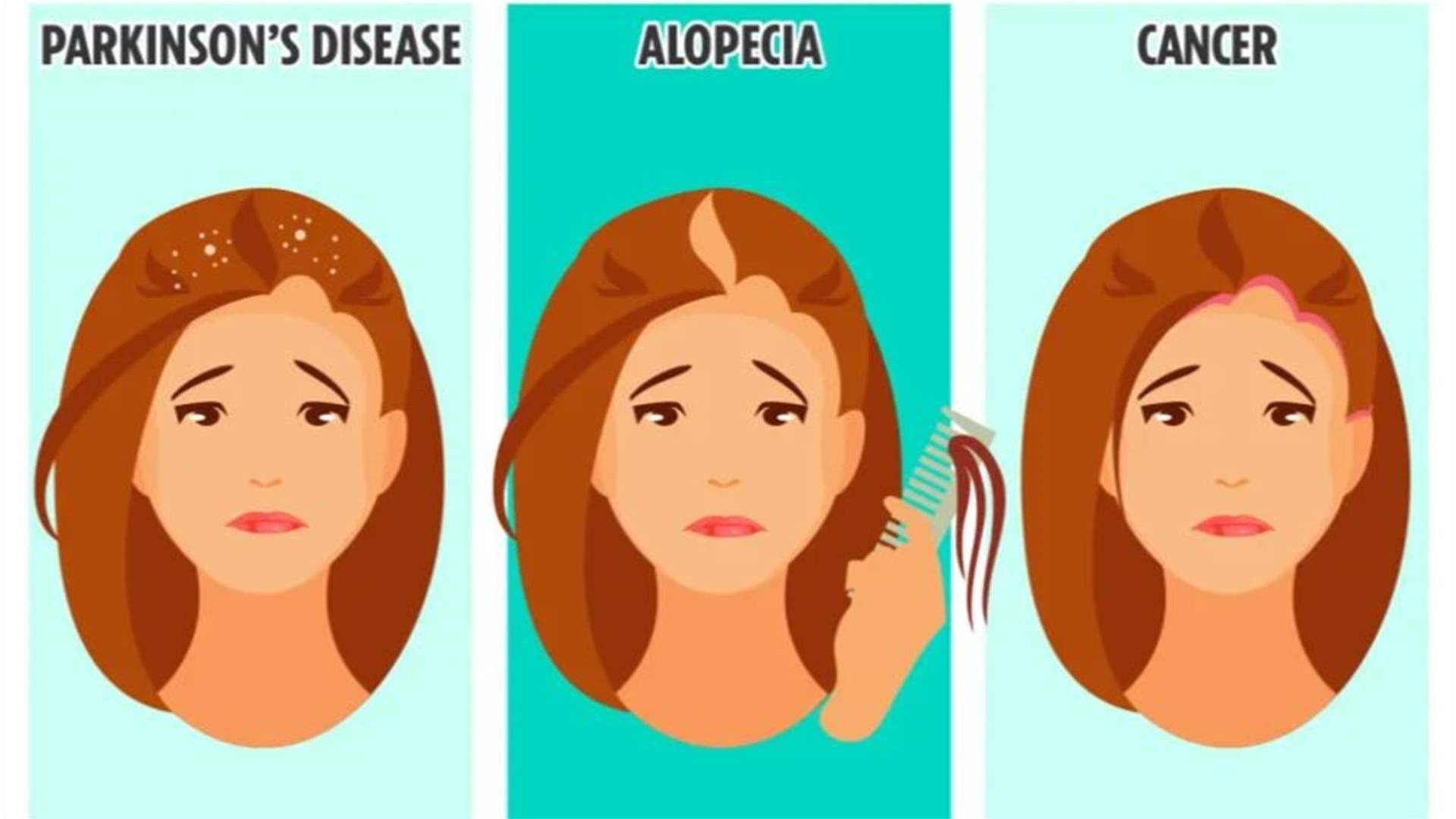 من القشرة إلى تساقط الشعر... اليكم هذه العلامات لثلاثة أمراض خطيرة كامنة في الشعر!