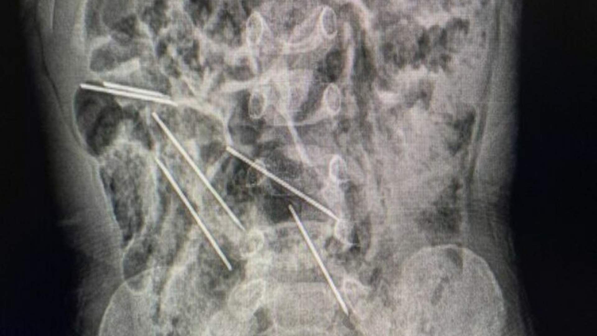 طفل ابتلع ثماني إبر طبية...إليكم ما حصل!