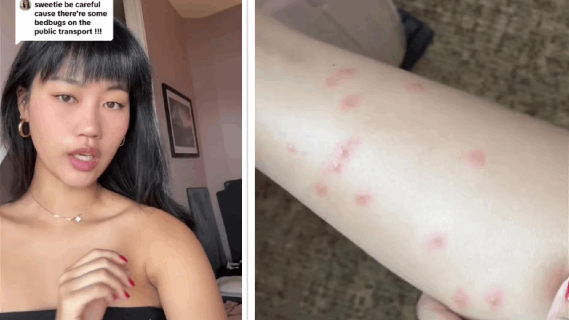 هكذا تعرضت للاصابة من البق...ما حصل مع مؤثرة التواصل الاجتماعي في فرنسا مخيف! 