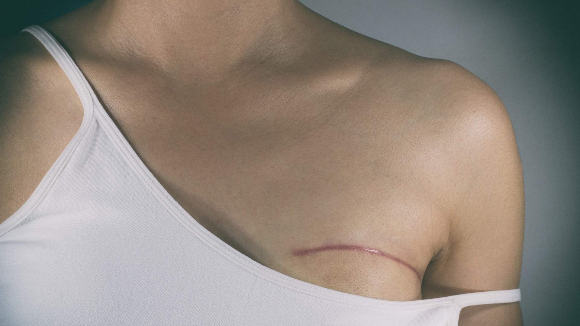 بعد استئصال ثدييها...امرأة تتحدث كيف أثرت هذه التجربة على أنوثتها!