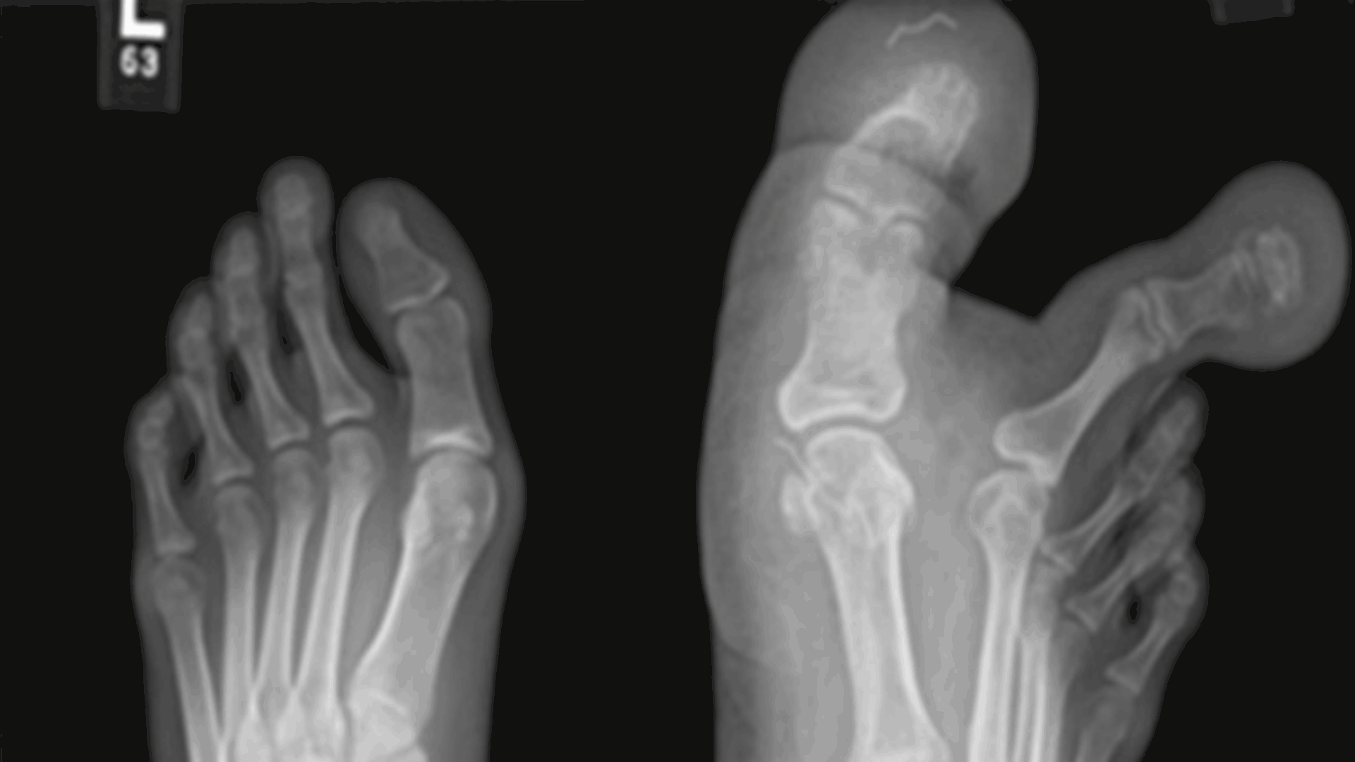 لم تكن قادرة على ارتداء الأحذية وتواجه صعوبة بالمشي... إبنة الـ12 سنة عانت كثيرا والسبب: أصابع قدمها العملاقة! (صور)