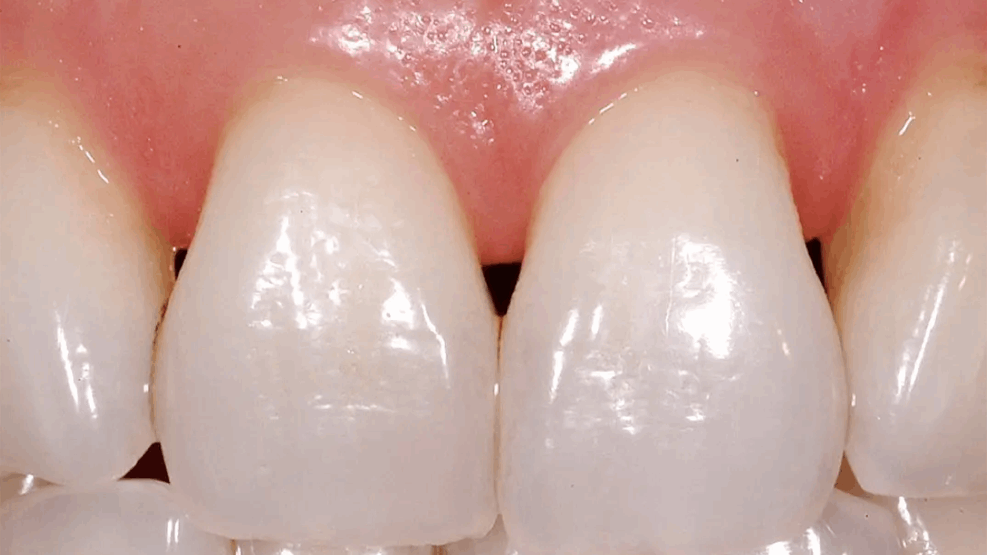 ما هي &quot;المثلثات السوداء&quot; بين أسنانك وكيف يمكن إصلاحها؟