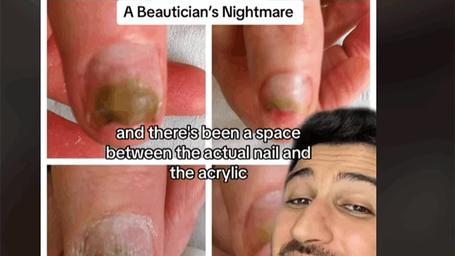 أظافر الأكريليك قد تكون خطيرة ومعدية... هل سمعتم بـ"كلورونيشيا" أو متلازمة الأظافر الخضراء؟! (فيديو)