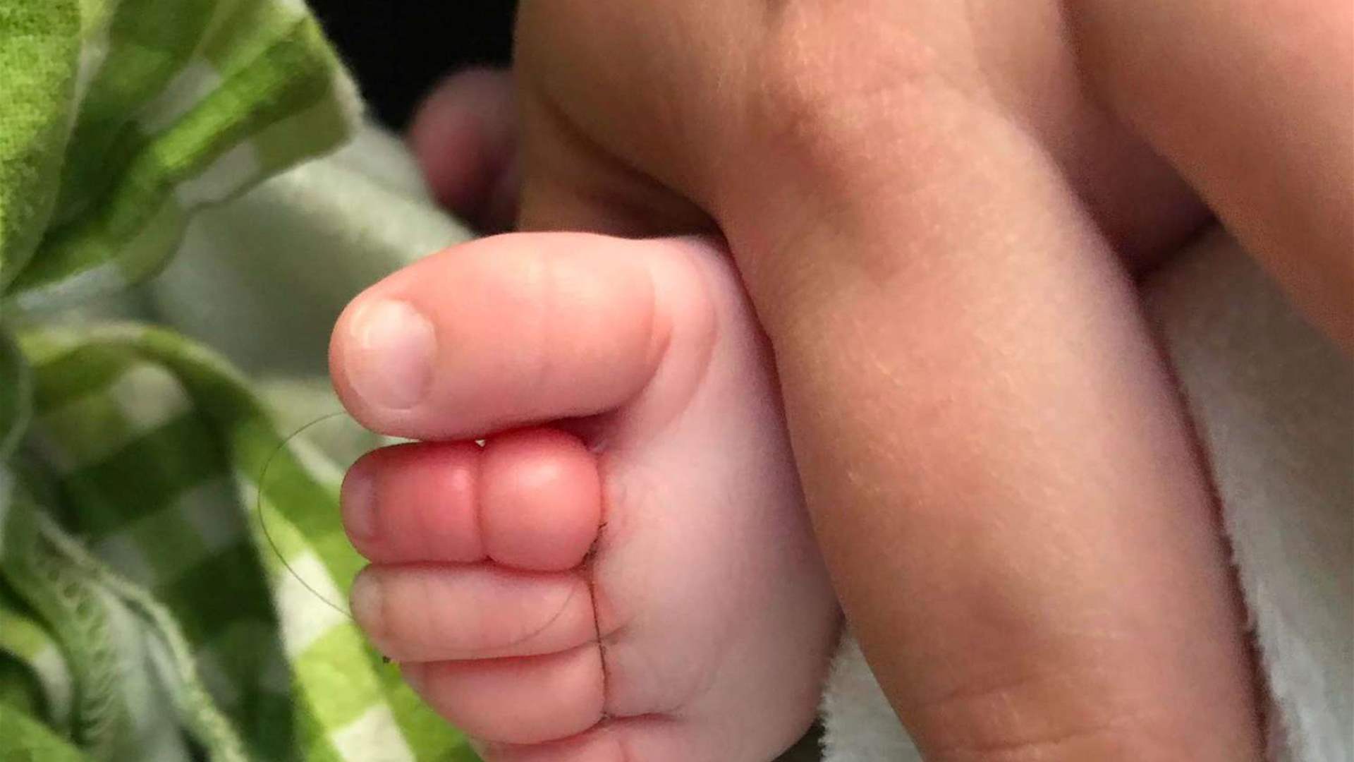 التف حول إصبعها خصلة من شعر والدتها... معاناة عاشتها رضيعة وهذه النتيجة (صورة)