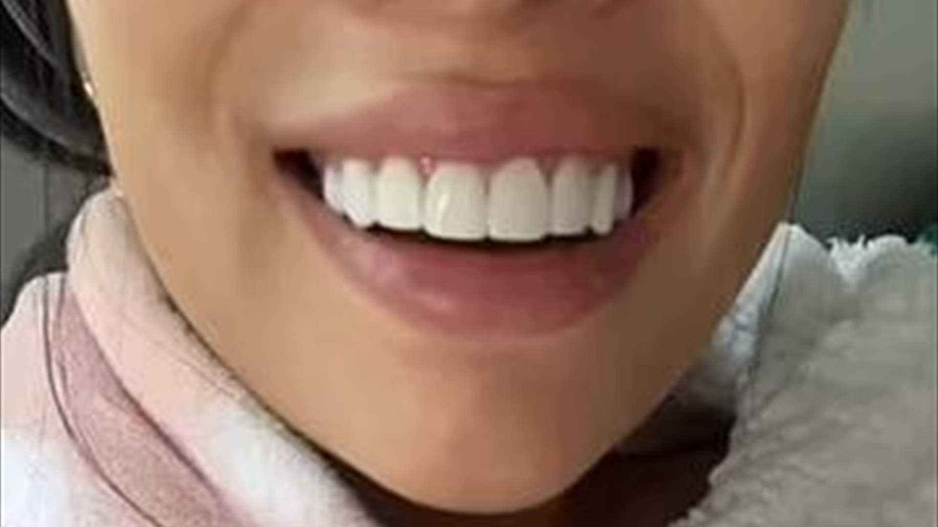 اتخذت قرارًا خاطئًا واعتمدت  تركيبة "الفينير" لأسنانها... استغلال الطبيبة جعلها تدفع مبالغ هائلة!
