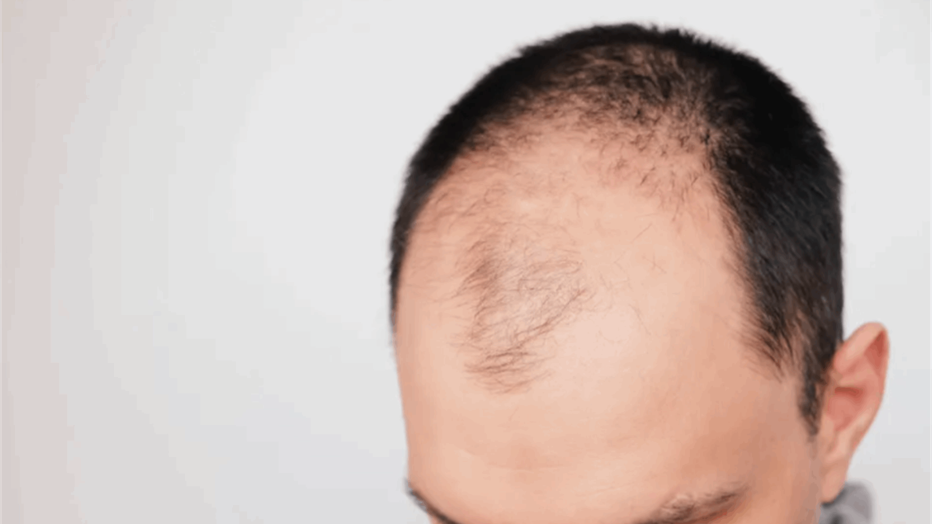 منها الأدوية... 5 أسباب تؤدي إلى تساقط الشعر: اكتشفوها الآن!