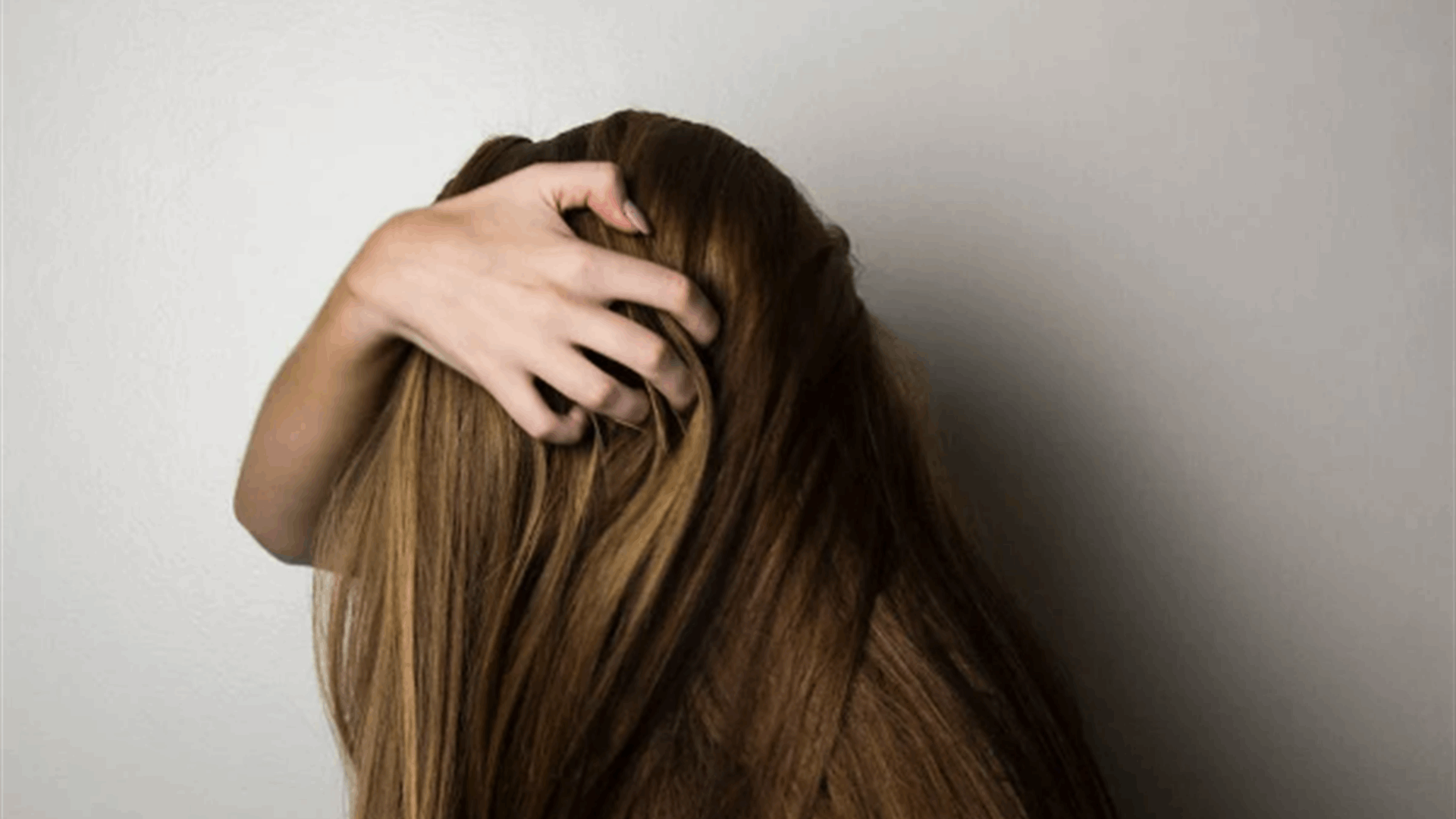 خصلة شعر تنمو في نصف جبهتها... حالتها الغريبة لم تمنعها من أن تصبح عارضة أزياء! (صورة)