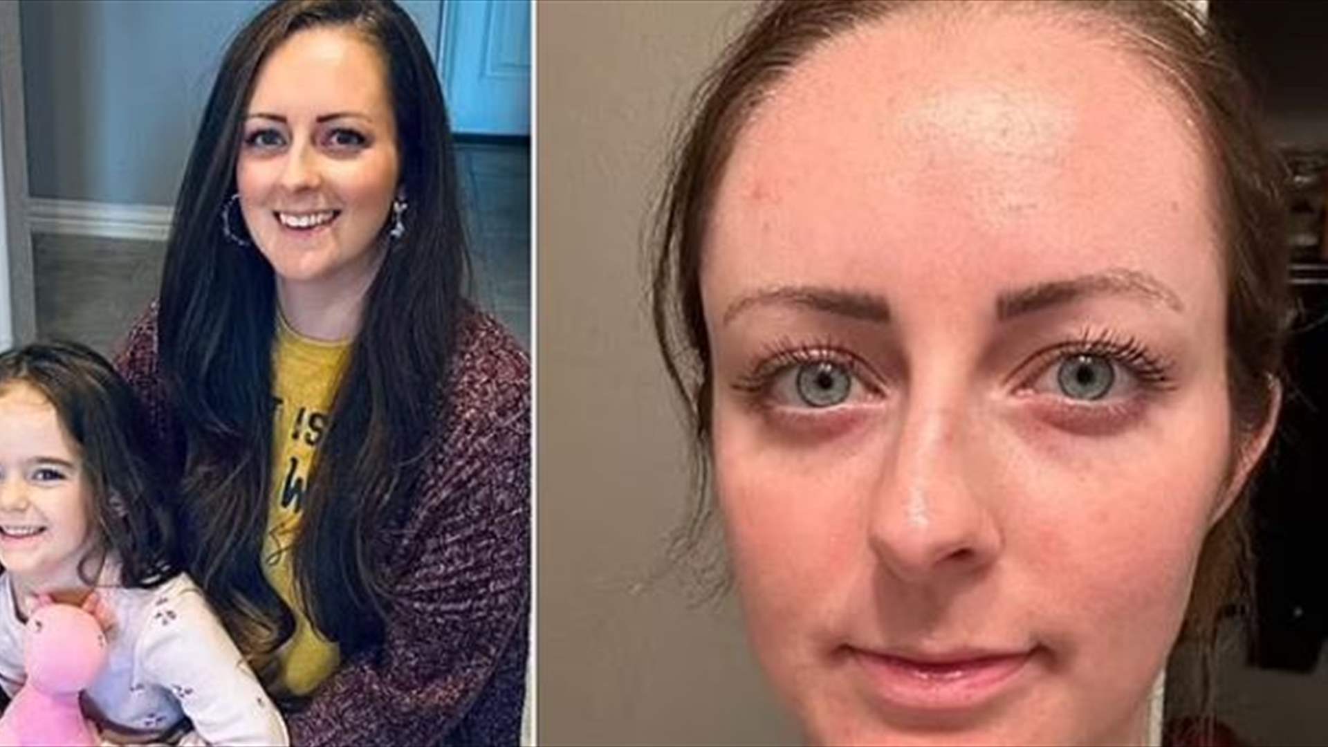 اعتقدت أنها مجرد بثرة صغيرة على جبينها... ثم حلت المفاجأة بتشخيص صادم!
