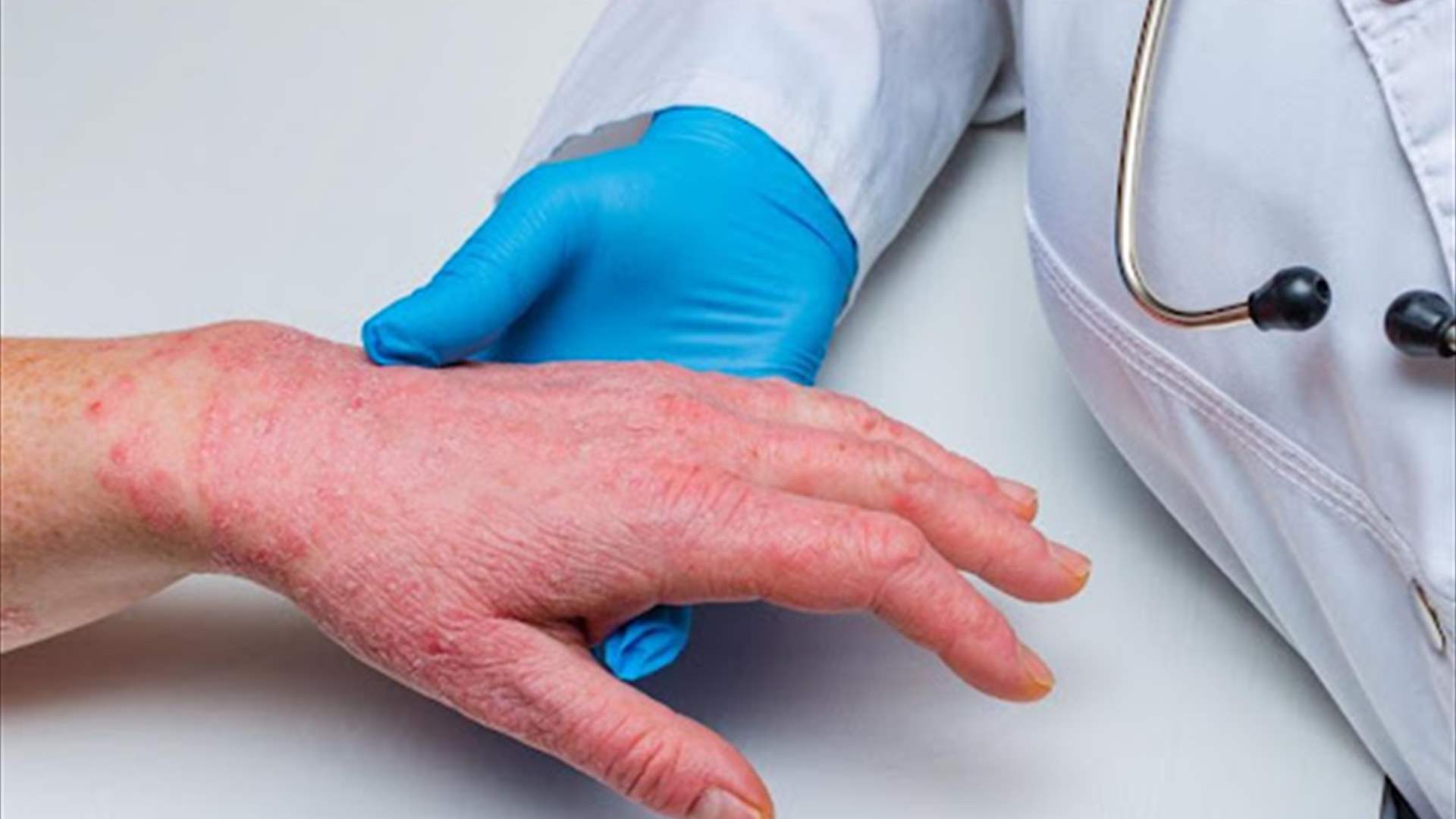 Public Health Ministry: No new cases of Mpox have been recorded in Lebanon since March