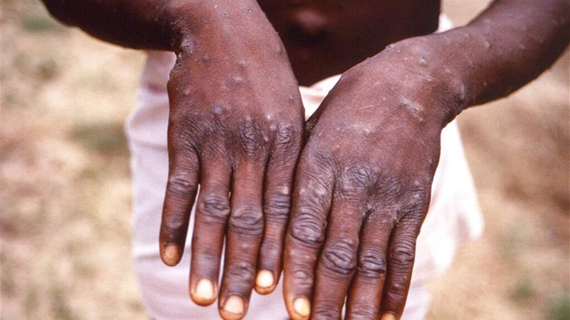 تسجيل إجمالي 18737 إصابة محتملة أو مؤكدة بجدري القردة منذ مطلع العام في إفريقيا