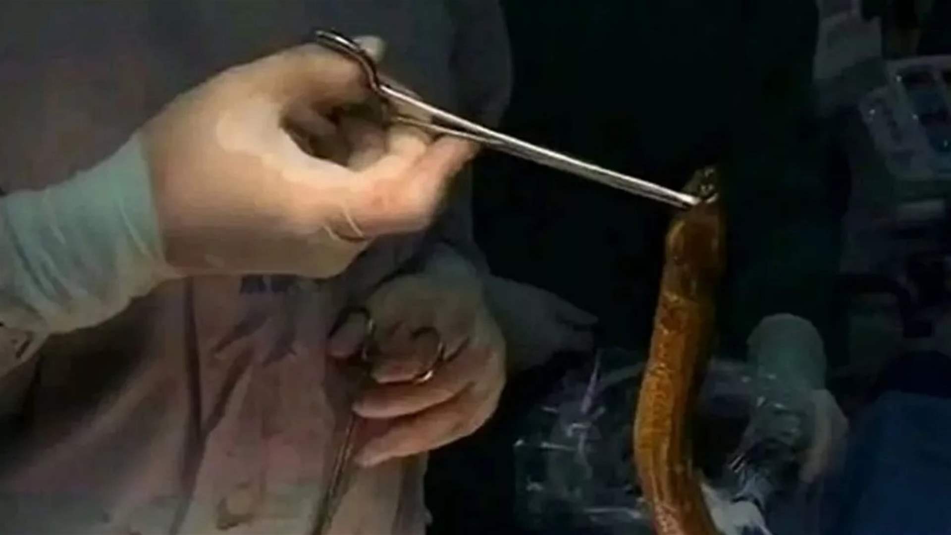 استخراج ثعبان بحر من جسم رجل... لن تصدقوا ما وجده الأطباء أيضاً!(صور)