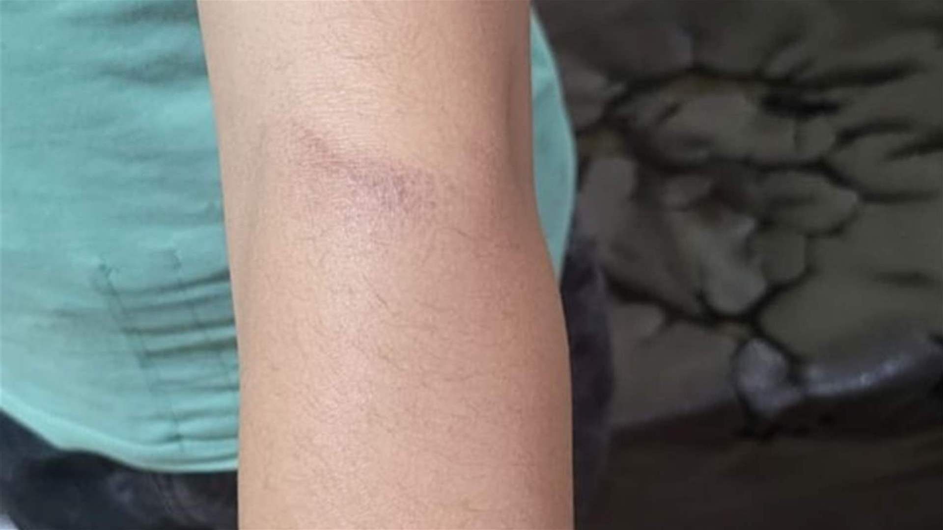 في البقاع: أم تعنّف أطفال زوجها وتحرق ابنته بسكين!