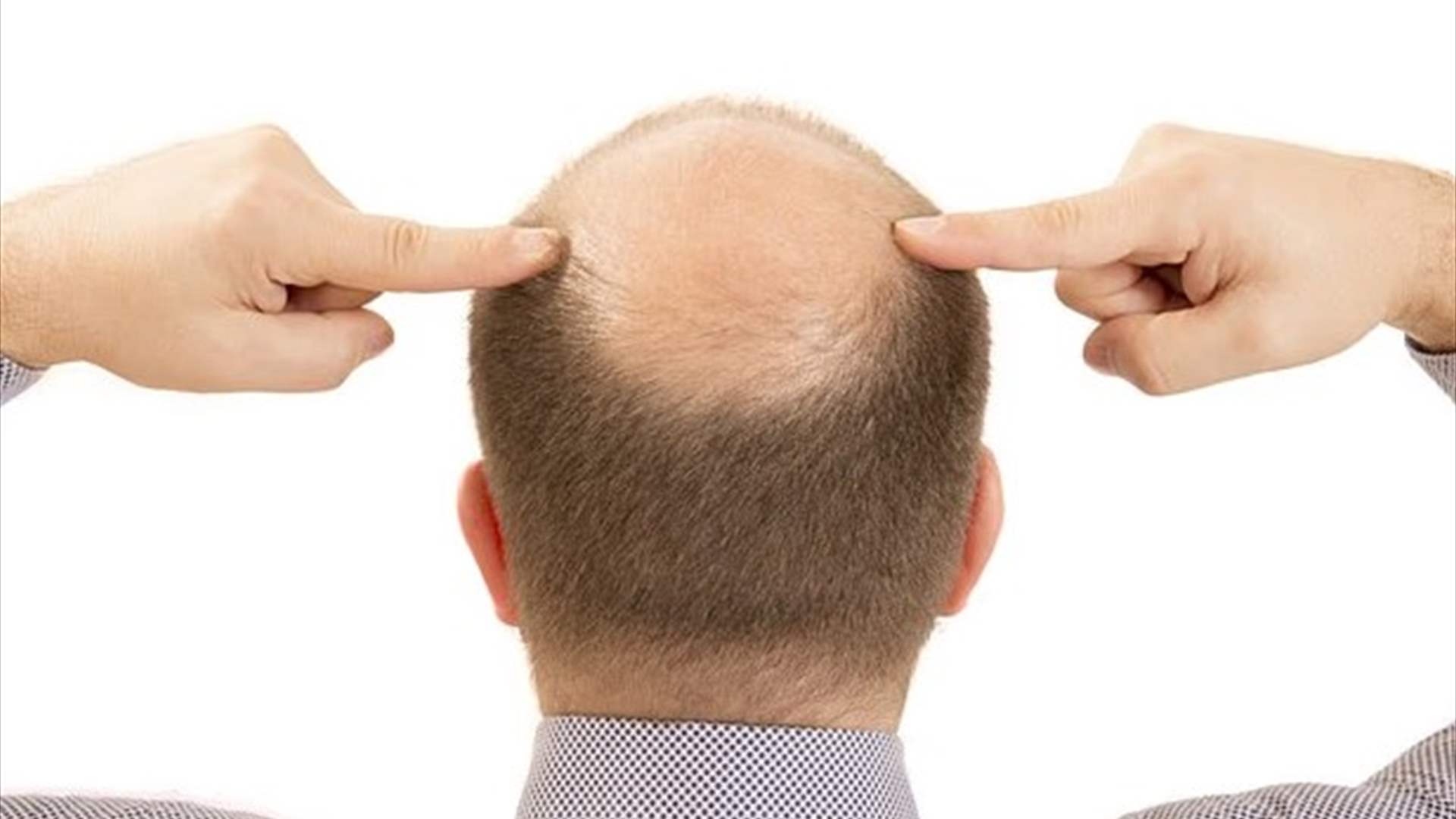 وداعاً للصلع... مصل جديد يُعيد الشعر خلال 20 يوماً فقط