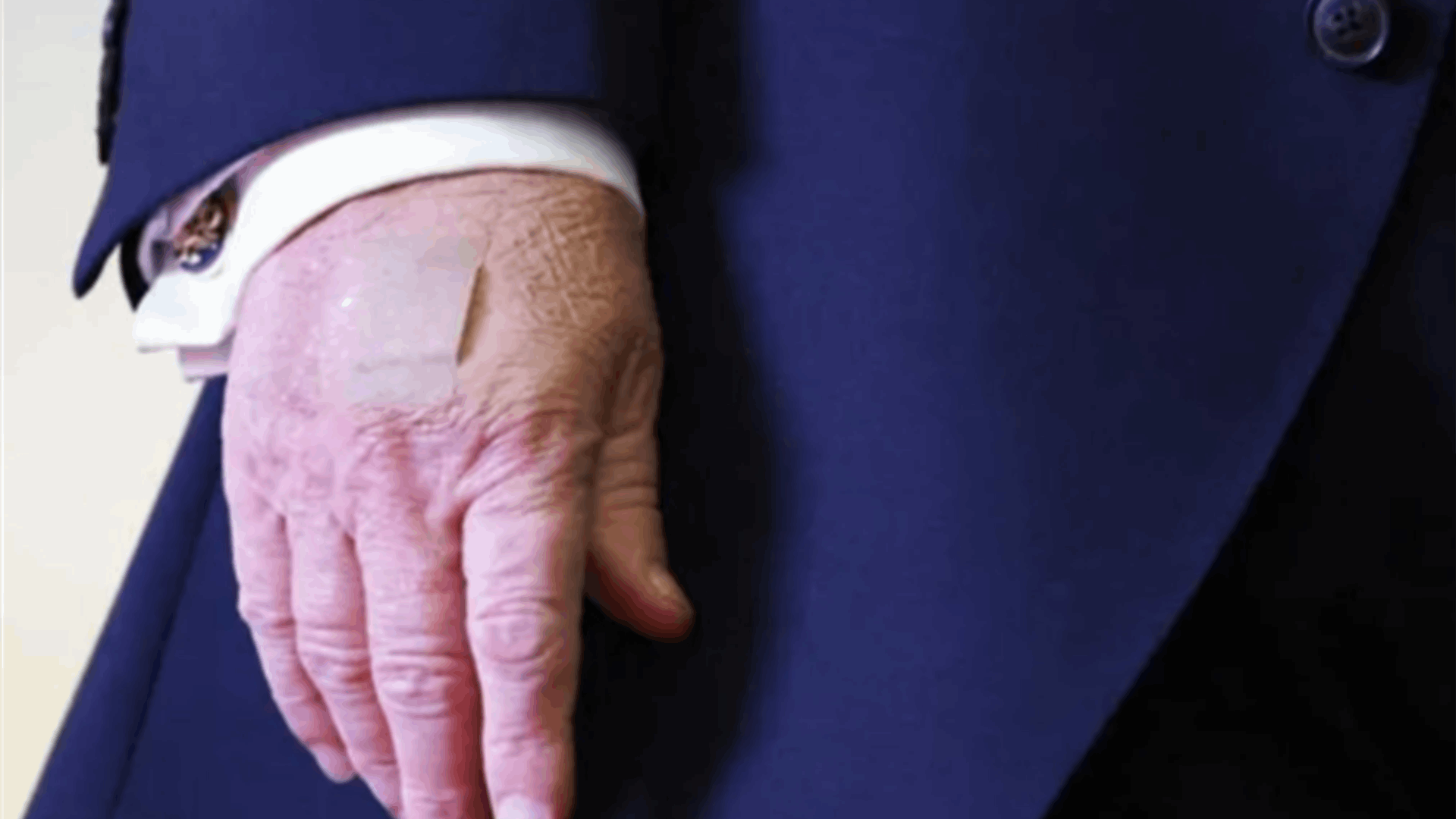 ترامب يكسر صمته بشأن سبب ظهور كدمات على يده