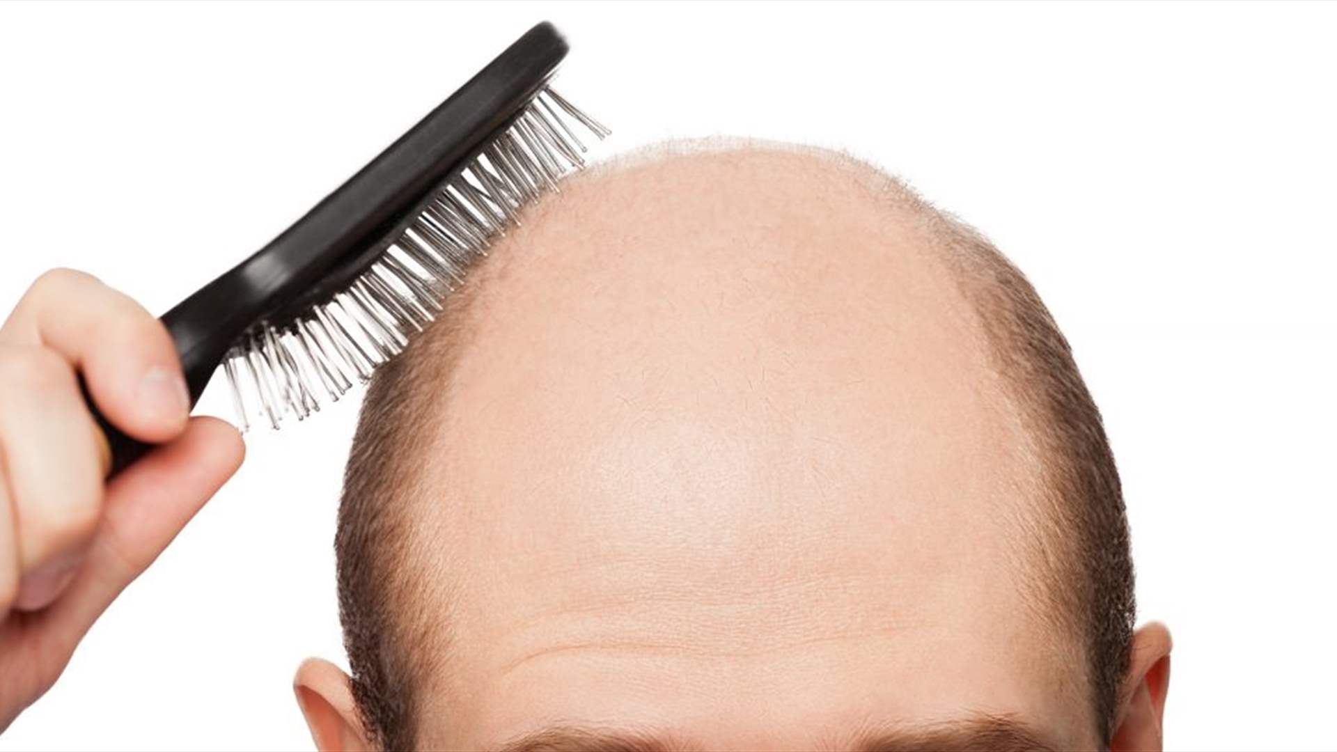 أمل جديد لملايين المصابين بالصلع… مكوّن طبيعي يعزّز نمو الشعر
