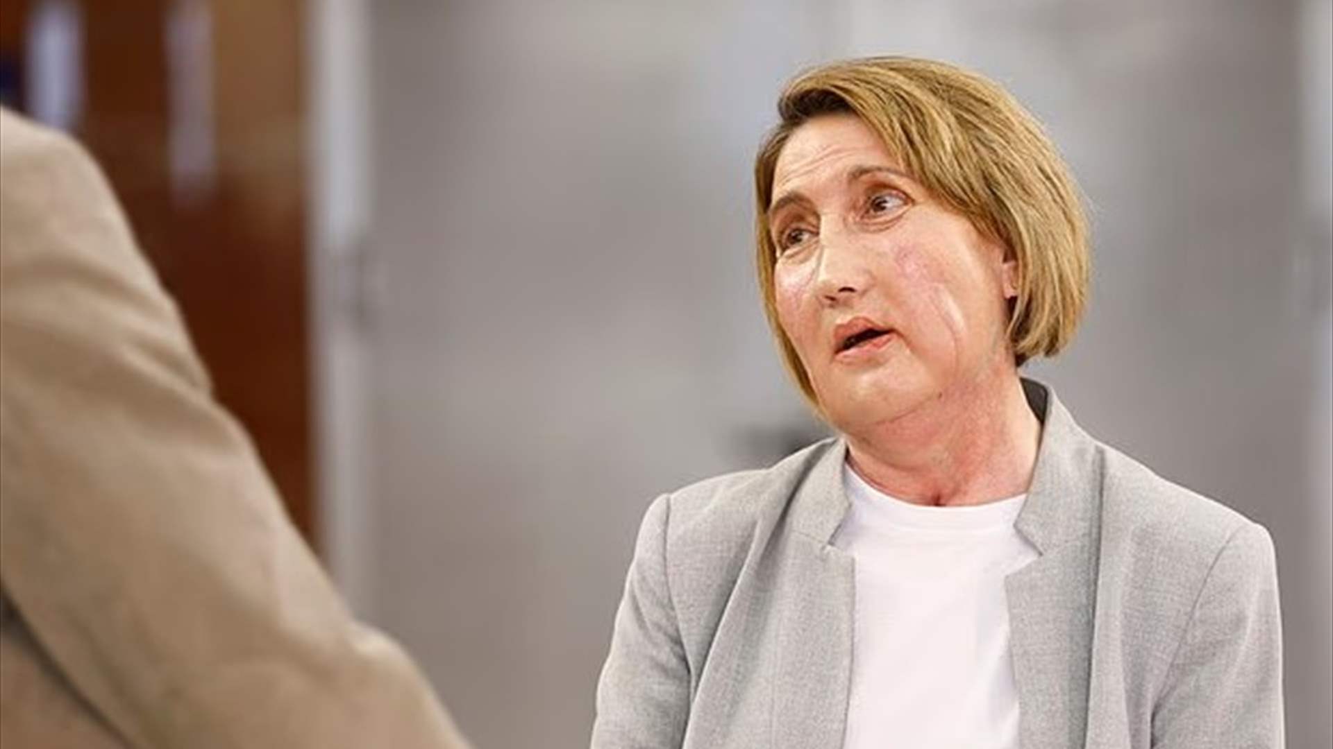 تبرّعت بوجهها قبل أن تموت… عملية تاريخية لزرع الوجه تُذهل الأطباء في إسبانيا