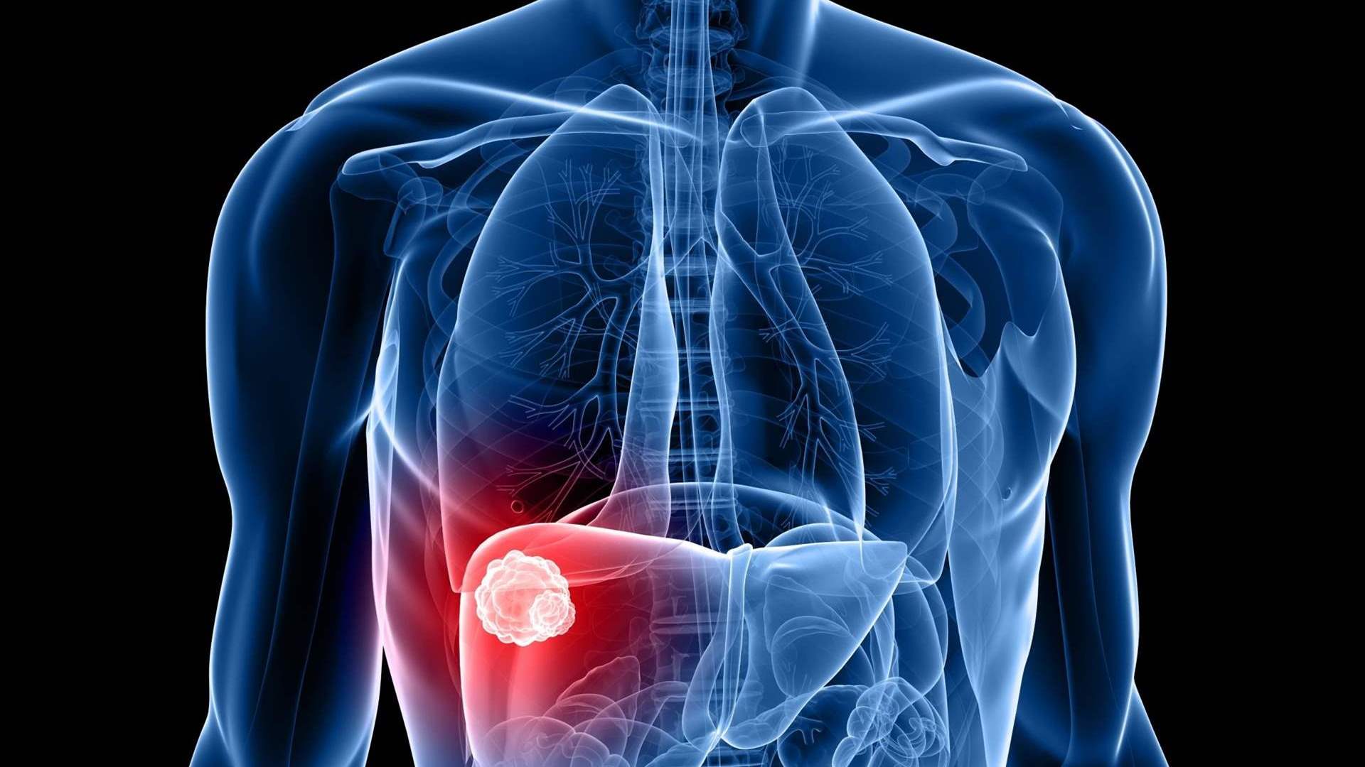 علامة شائعة قد تدّل على الإصابة بسرطان الكبد... والخبراء يحذّرون!