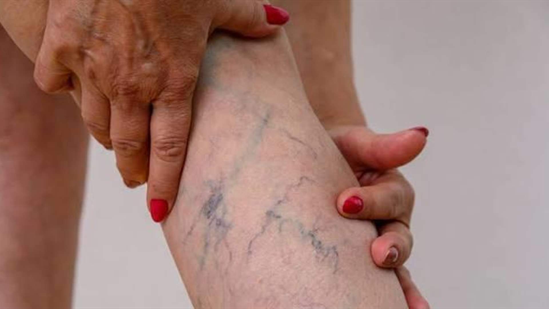 الجلوس والوقوف طويلاً… كيف تعالج دوالي الساقَين قبل تفاقمها؟