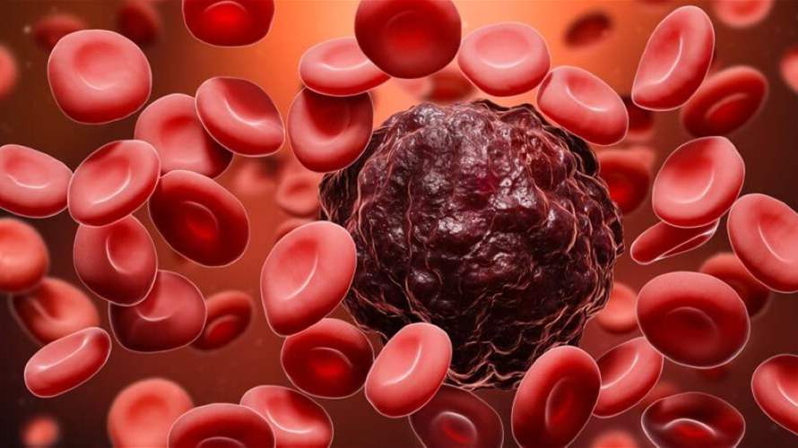 بنسبة 74 بالمئة...علاج جديد يقلّص خطر تقدّم نوع نادر من سرطان الدم