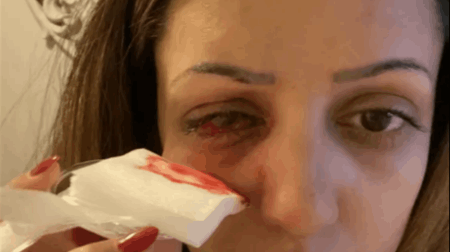 التقطت عدوى خطيرة في عينها جعلتها تفقد بصرها...ما حصل معها غير متوقّع!