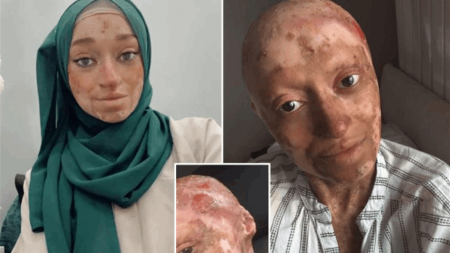 البثور المليئة بالقيح تجعلها ملتصقة بفراشها وبملابس النوم... شابة تعاني من مرض غير قابل للشفاء وهذه حالتها! (صور)