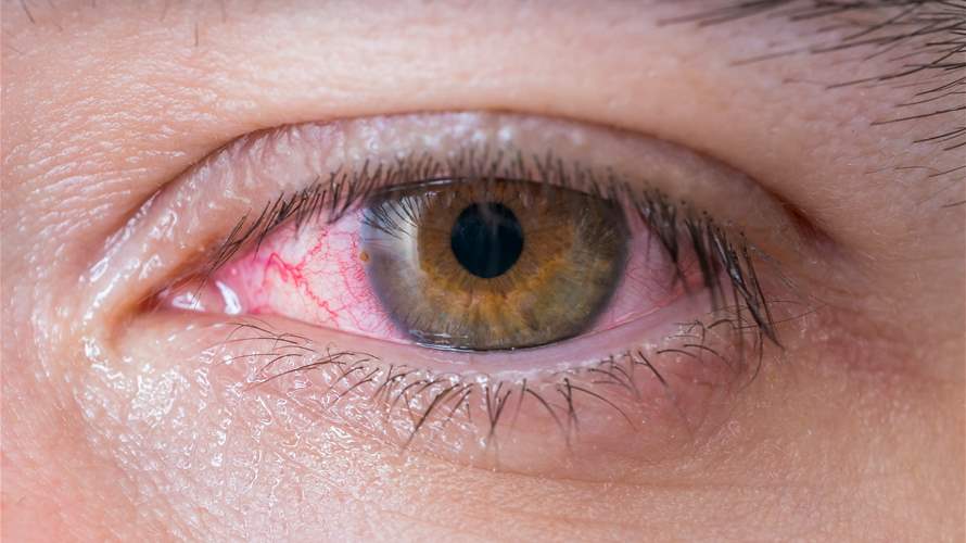 سرطان العين النادر... ما هو وكيف يمكن اكتشافه؟