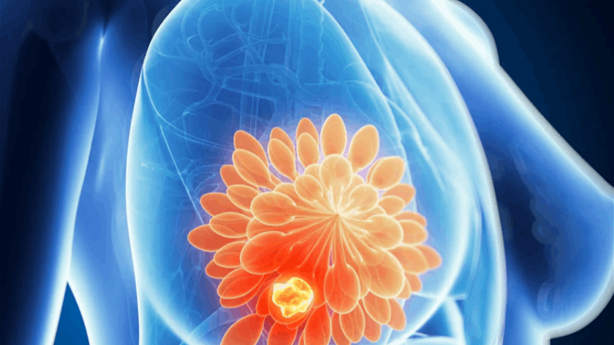 خرق جديد لسرطان الثدي... اكتشاف يساعد في قتل الخلايا السرطانية النائمة: هل يمنع عودة المرض الخبيث؟!