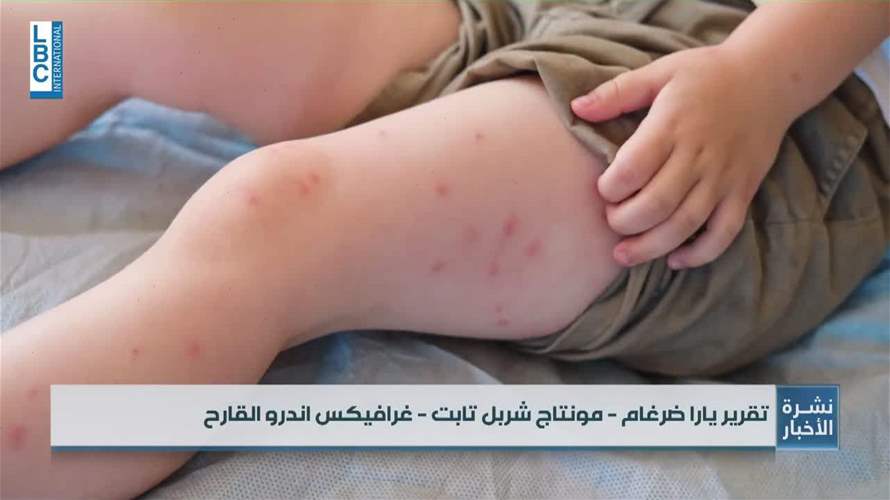  مرض الحصبة في تكساس بين الموت واللقاح!