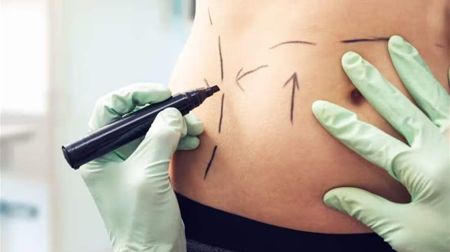 عملية شفط الدهون: الإجراء التجميلي الأكثر أماناً على الإطلاق... وهذه التفاصيل!