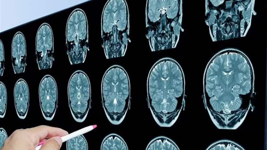 معدلات الخرف تسجّل ارتفاعًا ملحوظًا... والعلماء يشرحون الأسباب