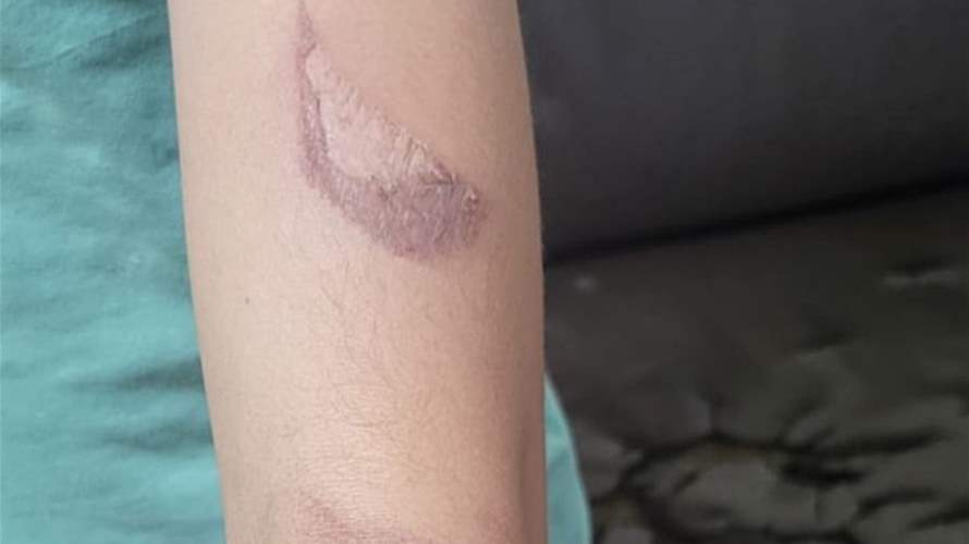 في البقاع: أم تعنّف أطفال زوجها وتحرق ابنته بسكين!