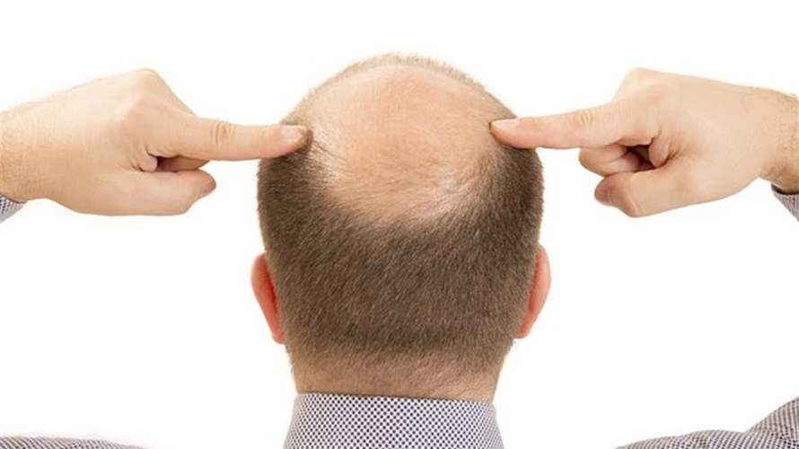وداعاً للصلع... مصل جديد يُعيد الشعر خلال 20 يوماً فقط