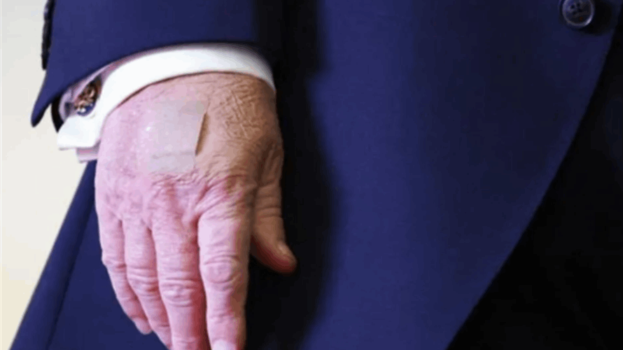 ترامب يكسر صمته بشأن سبب ظهور كدمات على يده