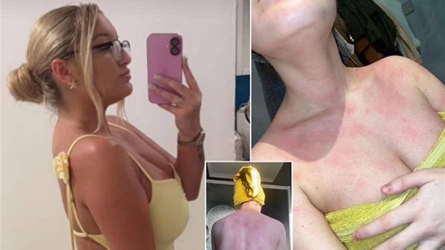 "حبيسة جسدها".. شابة تروي مأساتها مع حساسية الماء: "حتّى دموعي تحرقني!"