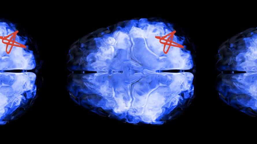 إنجاز طبي صيني... جراحة ثورية لتصريف البروتينات السامة من الدماغ قد تعيد الأمل لمرضى الخرف